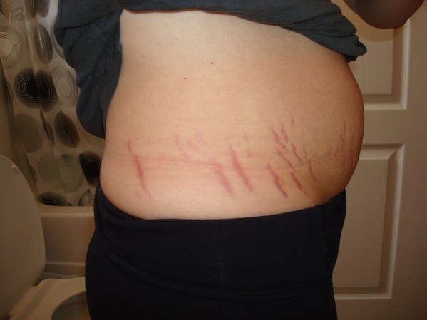 Stretch Marks, left